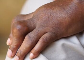 Goutte : Recette ingénieuse de grand-mère pour la soigner