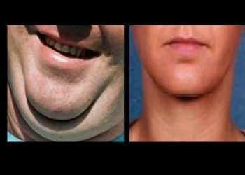 Bien être : Ces techniques pour se débarrasser naturellement du double menton